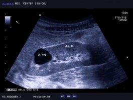 Ultrazvok ledvic - enostavna cista ledvice